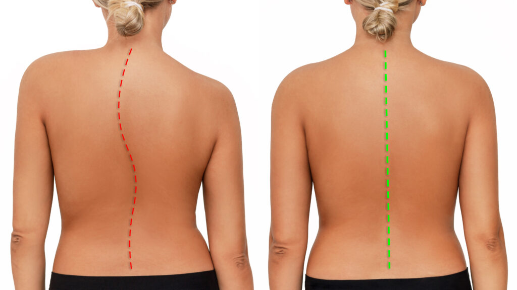scoliosis chiropractic care